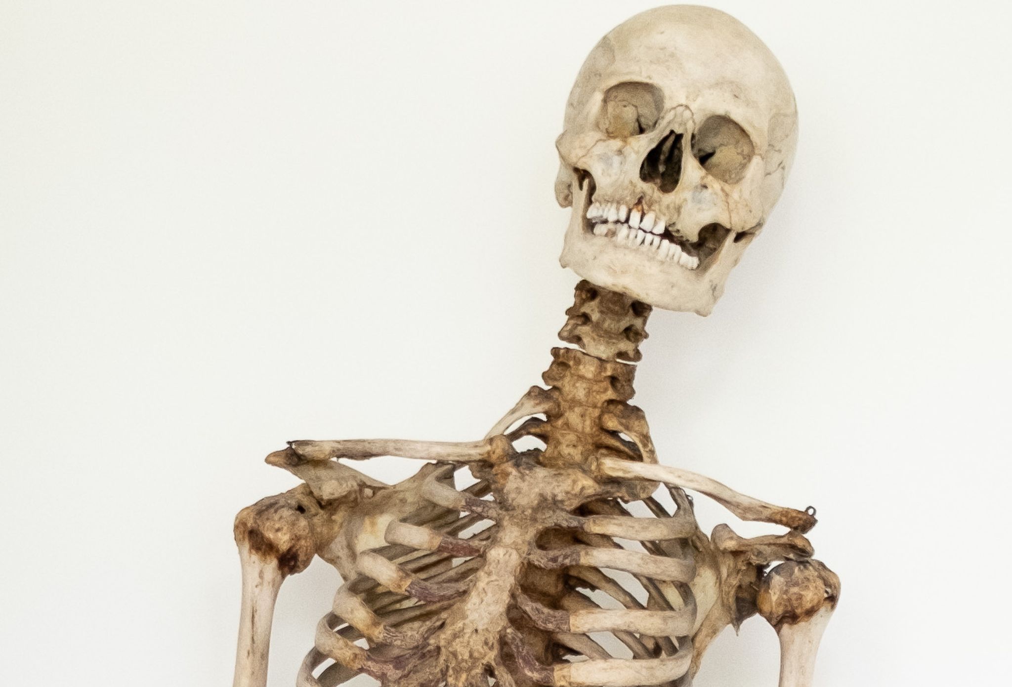 Dank wissenschaftlicher Analysen und eines Verwandten weiß man nun, dass dieses Skelett die sterblichen Überreste des Räubers Schinderhannes sind.