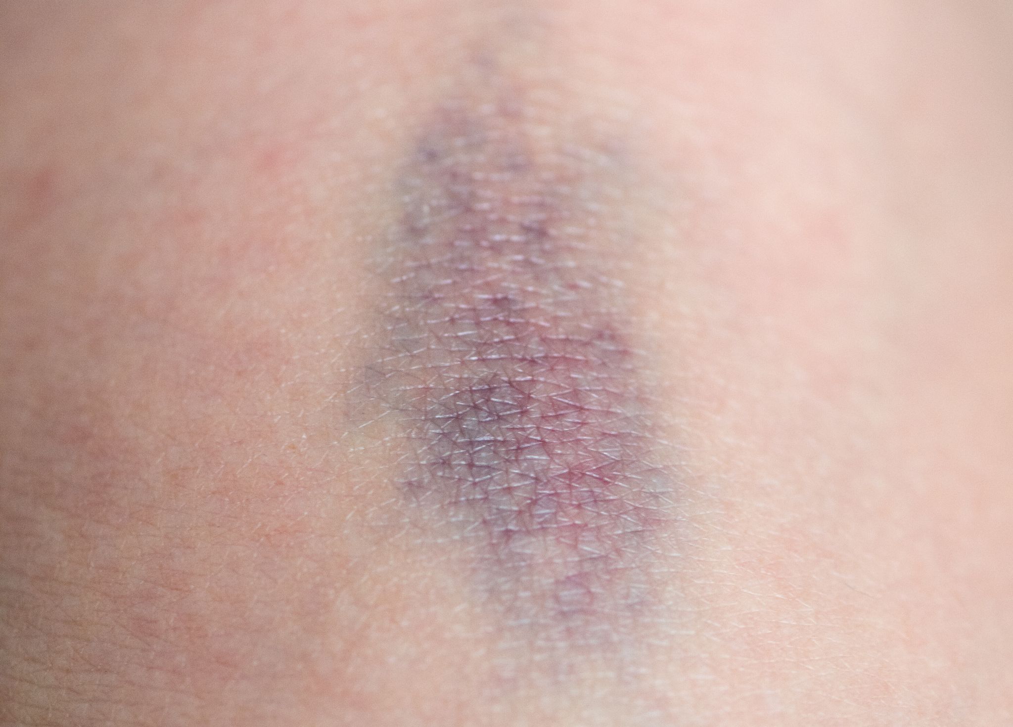 Wenn bereits leichte Stöße häufig zu blauen Flecken führen, kann das auf eine Störung der Blutgerinnung hinweisen.