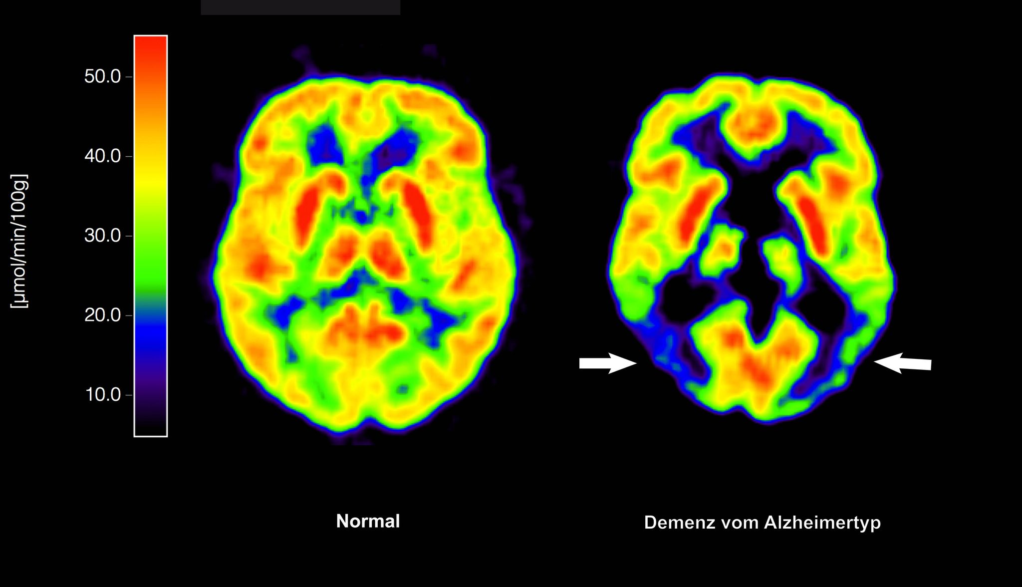 Lecanemab richtet sich gegen Amyloid-Ablagerungen im Gehirn und soll dadurch den Verlauf der Krankheit ein wenig verlangsamen. (Archivbild)
