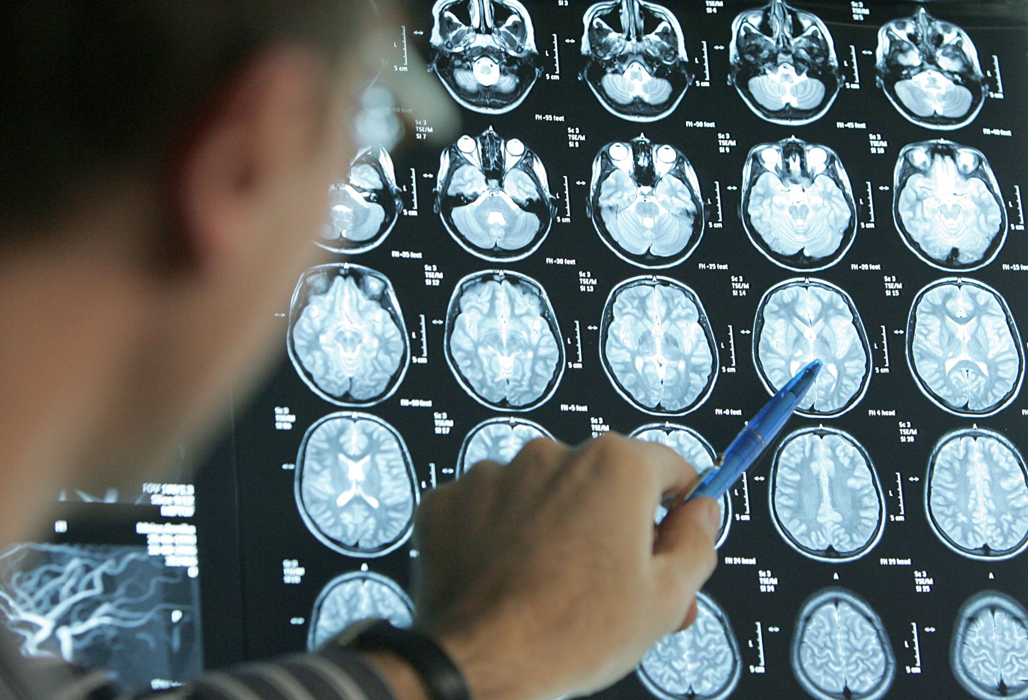 Wer einen Schlaganfall erleidet, ist im Durchschnitt rund 75 Jahre alt.