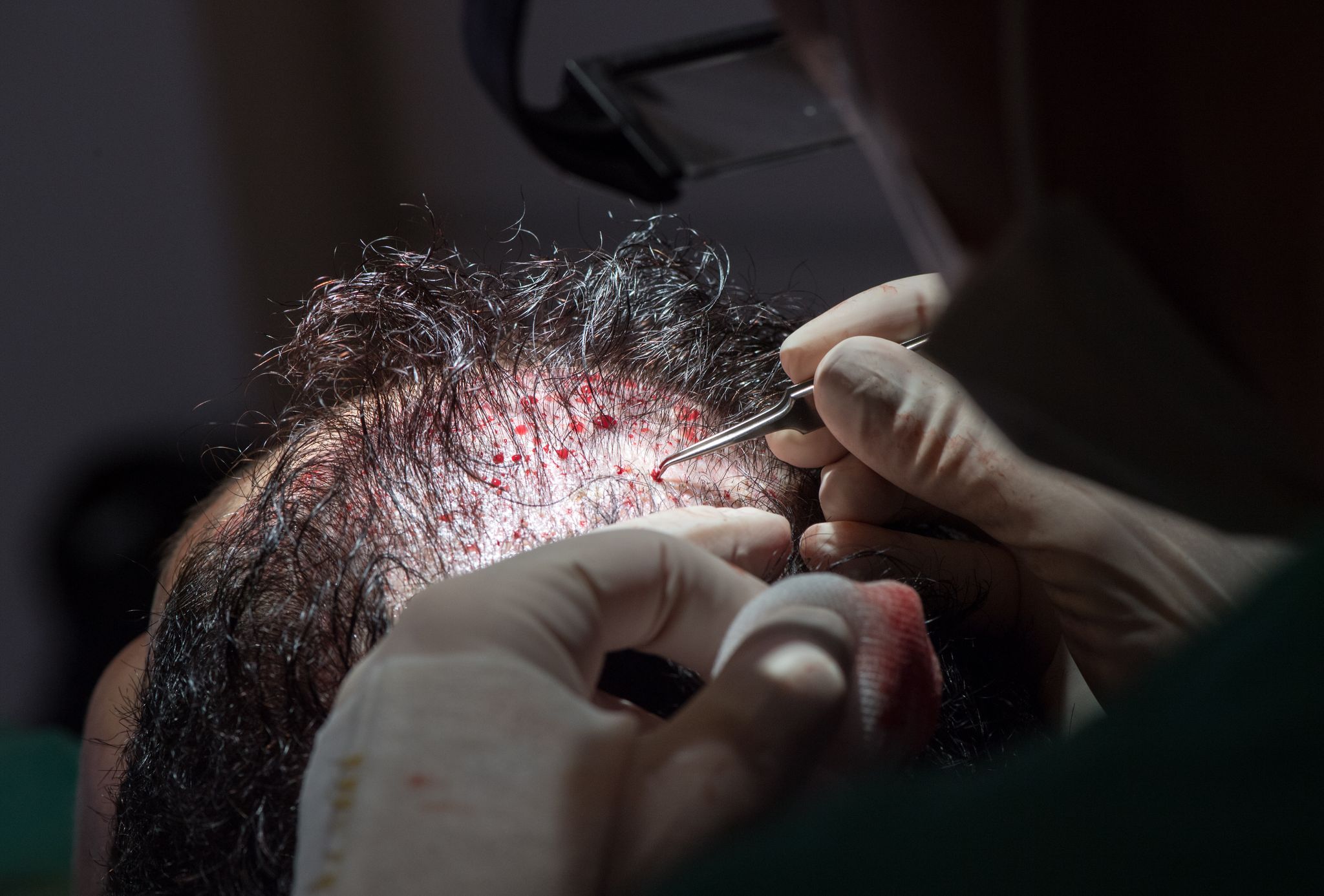 Unter bestimmten Voraussetzungen können die Kosten einer Haartransplantation steuerlich geltend gemacht werden.