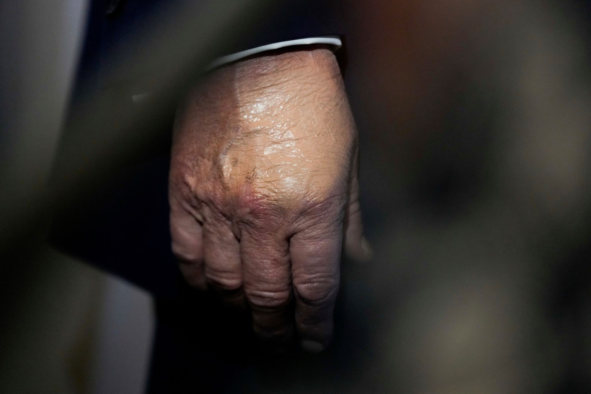 Nachdem der Bluterguss am Handrücken für Aufsehen sorgte, wurde er häufig bei Auftritten zugeschminkt. (Archivbild)